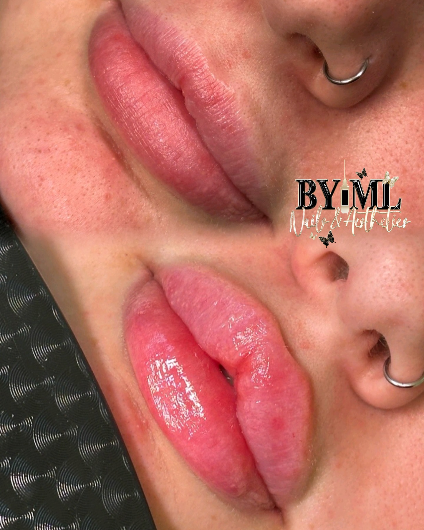 Lip Filler before and after comparison